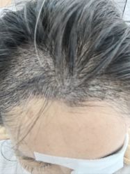 点击看大图 -大麦微针植发丨全国连锁