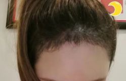 -大麦微针植发丨全国连锁