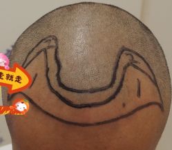 -大麦微针植发全国连锁