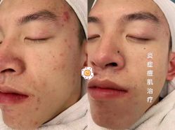 -美肤盾祛痘·问题肌头疗管理中心