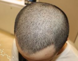 -大麦微针植发丨全国连锁