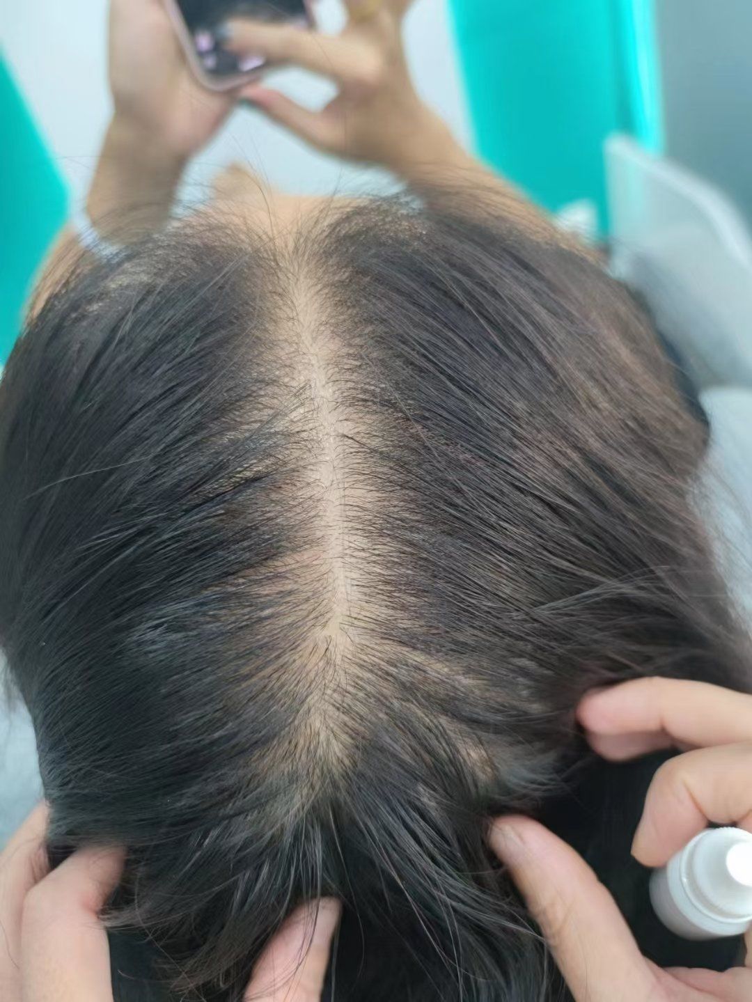 女性弥漫性脱发