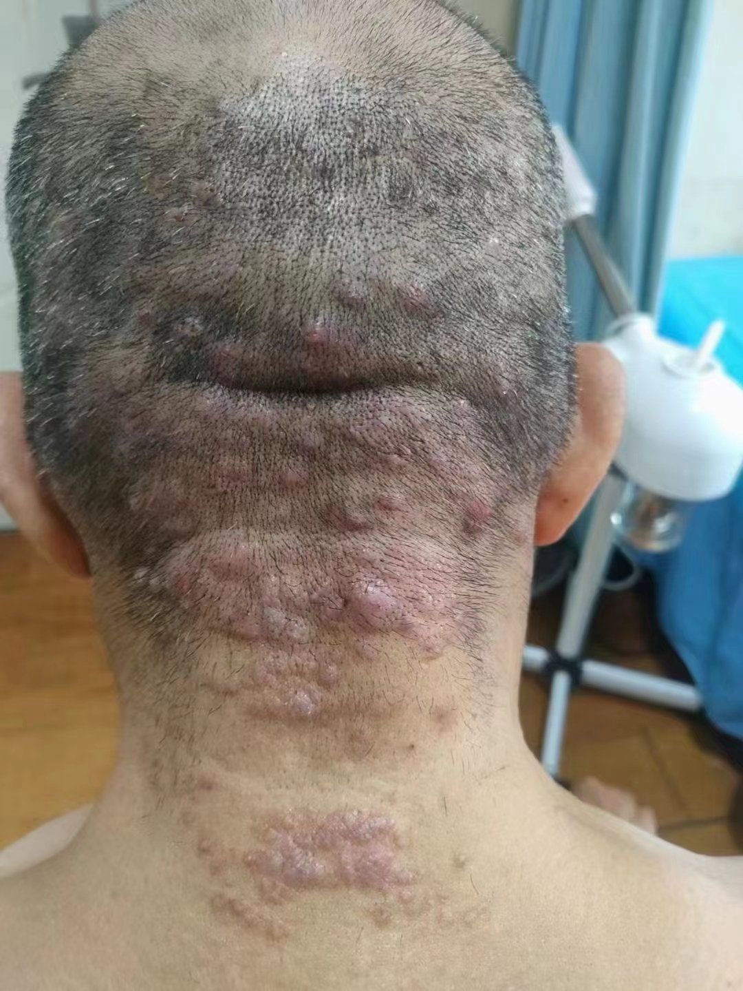 毛囊炎不请自来?看这里!