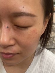 体验前-北京美痣堂古方祛痣斑疣瘊