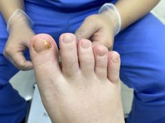 -Andrew指甲专科灰指甲·甲沟炎矫正·3D步态矫形鞋垫定制(浦三路店)