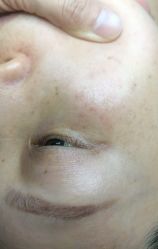 -爱莎扁平疣·汗管瘤·斑痣中心