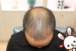 -大麦微针植发丨全国连锁