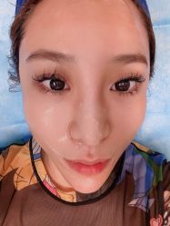 体验后-针美汇欧邦医疗美容