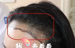 -大麦微针植发全国连锁