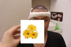 -大麦微针植发丨全国连锁