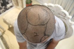 点击看大图 -大麦微针植发丨全国连锁