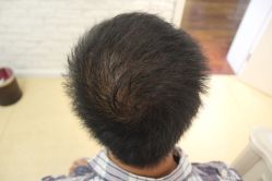 点击看大图 -大麦微针植发丨全国连锁