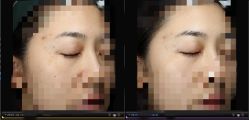 -丽美妍医疗美容·皮秒·立体分层抗衰