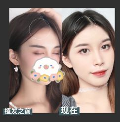 -碧莲盛·不剃发植发
