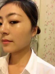 祛斑一周后-百秀名媛纹绣美学护肤中心