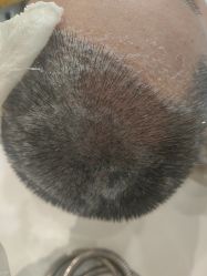 -碧莲盛·不剃发植发