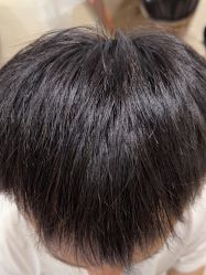 点击看大图 -碧莲盛·不剃发植发