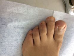 -德哥灰指甲脚气甲沟炎跖疣护理
