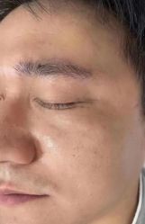 -北京美痣堂古方祛痣斑疣瘊