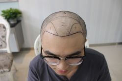 -大麦微针植发丨全国连锁