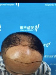 -雍禾植发全国连锁