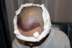 -大麦微针植发丨全国连锁