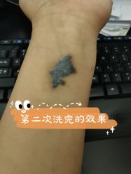 -一次性洗纹身·修复疤痕·超皮秒