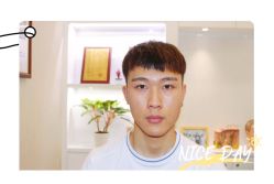 点击看大图 体验后-大麦微针植发全国连锁