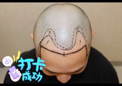 点击看大图 体验后-大麦微针植发全国连锁