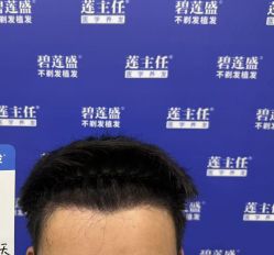 -碧莲盛·不剃发植发