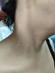 -北京美痣堂古方祛痣斑疣瘊