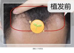 -大麦微针植发全国连锁