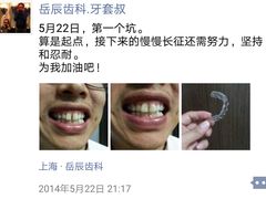 牙套叔日记-2014年5月22日-岳辰齿科(浦东长泰店)