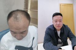 体验后-大麦微针植发丨全国连锁