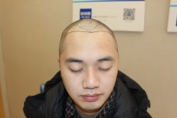 -大麦微针植发丨全国连锁