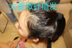-大麦微针植发丨全国连锁