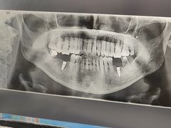 -上海仁爱医院口腔科 · 种植