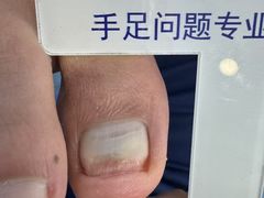 -Andrew指甲专科灰指甲·甲沟炎矫正·3D步态矫形鞋垫定制(浦三路店)