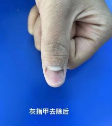 -德哥灰指甲脚气甲沟炎跖疣护理