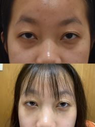 -广州健丽·去眼袋医疗美容机构
