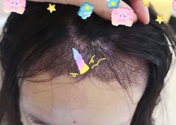 -大麦微针植发全国连锁