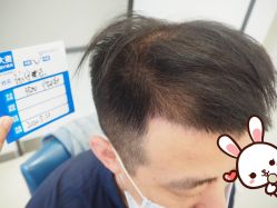 -大麦微针植发丨全国连锁