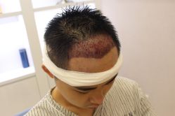 -大麦微针植发丨全国连锁