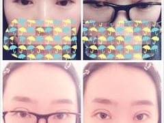 上面是术后第2、3天，下面是第5天。-上海华安整形外科门诊部