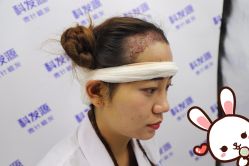 -大麦微针植发丨全国连锁