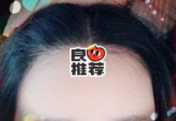 -大麦微针植发全国连锁