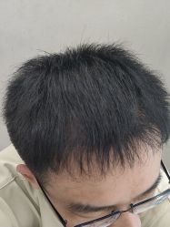 点击看大图 -大麦微针植发丨全国连锁