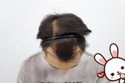 -大麦微针植发丨全国连锁