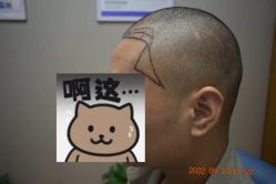 体验前-大麦微针植发全国连锁