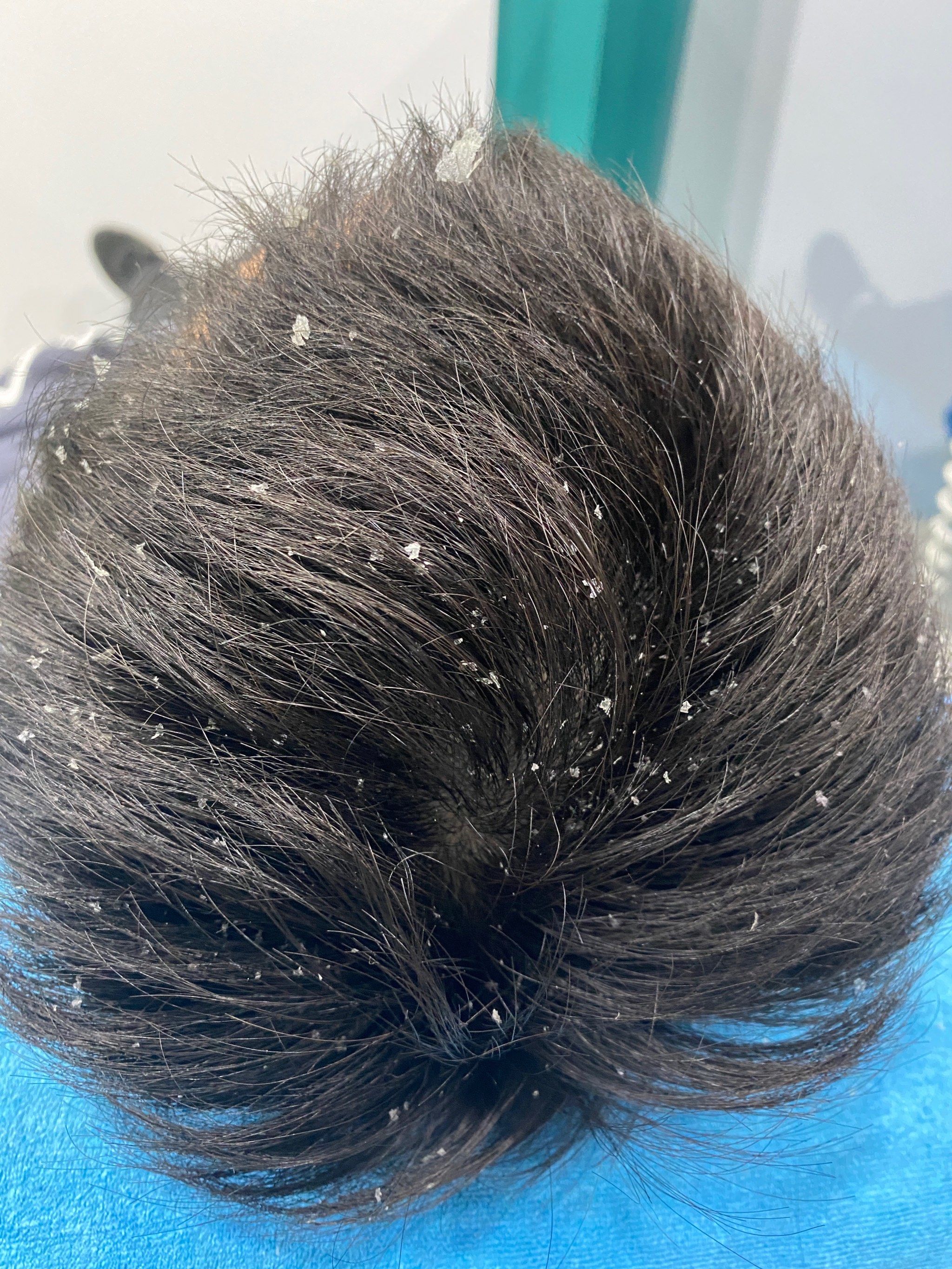 秋冬季节头皮痒,头屑多怎么应对?